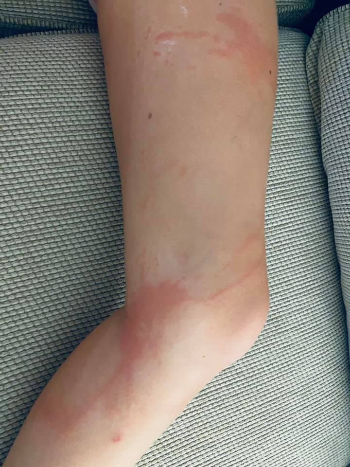 thumbnail image 2 of Sting Zapper Jellyfish First Aid Gel – 2 Pack, Fast Relief For Stings 2 of 4