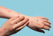 Local surveillance continues as monkeypox declared global emergency