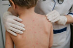 Six chickenpox cases reported in schools