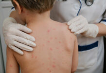 Six chickenpox cases reported in schools