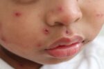 Measles in US at highest levels since 1992: Is Cayman at risk? measles