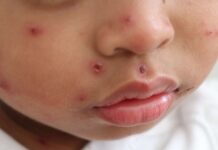 Measles in US at highest levels since 1992: Is Cayman at risk? measles